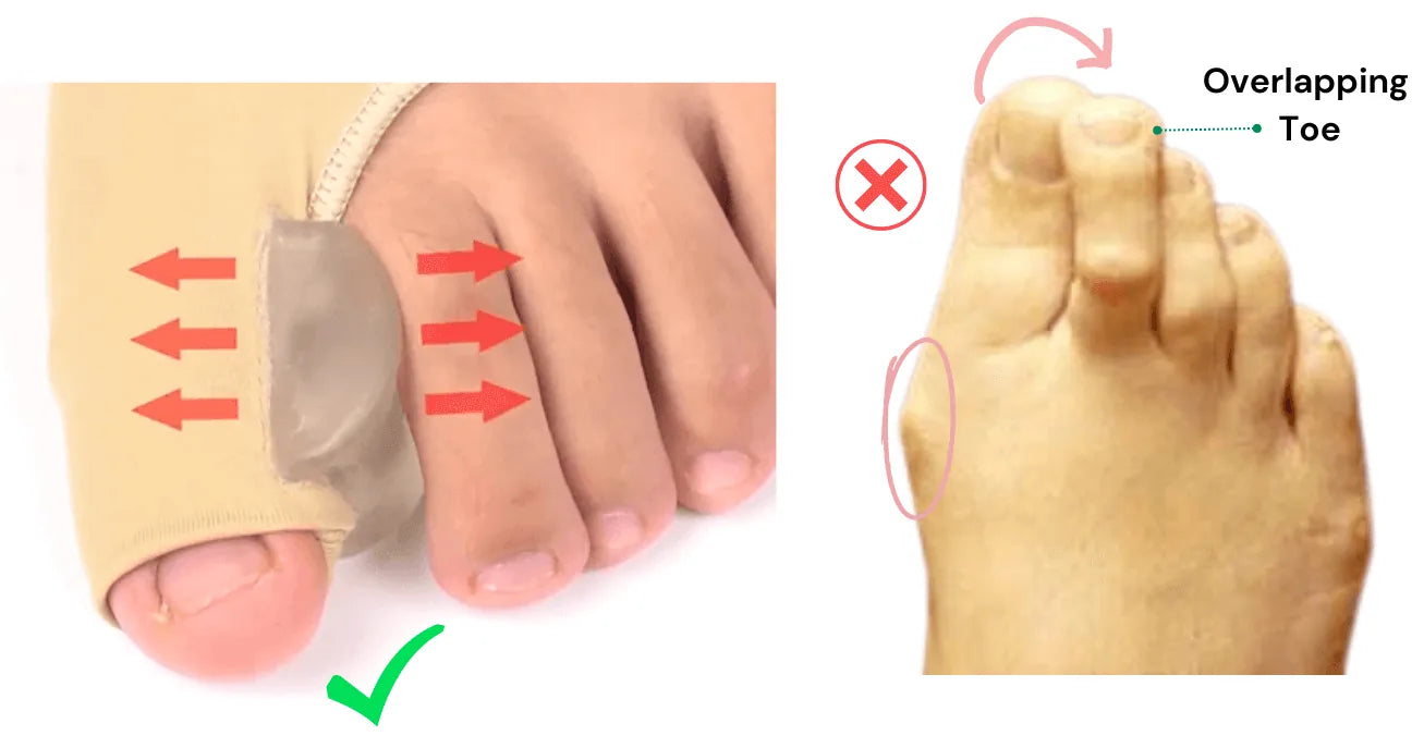 Gel Forefoot Cushion Sleeves – 1 Pair – product image 4